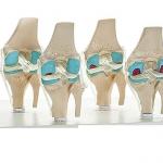 Knee 4 Stage Arthritis Model