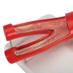Arteriosclerosis Model, with cross section of artery, 2 part | Anatomy Premium Quality Model