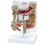 Colon Pathological Model Showing Various Pathologies