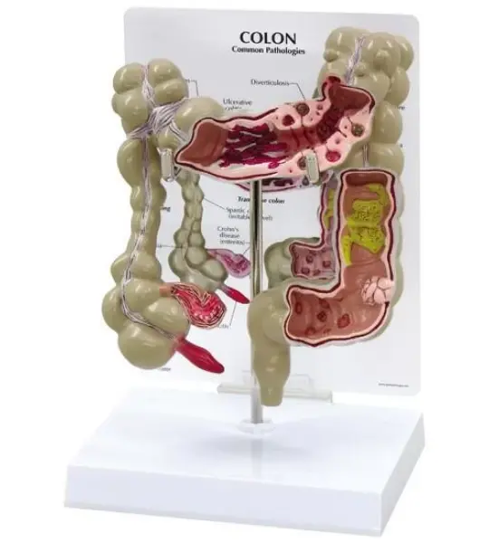 Colon Pathological Model Showing Various Pathologies