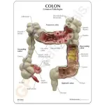 Colon Pathological Model Showing Various Pathologies