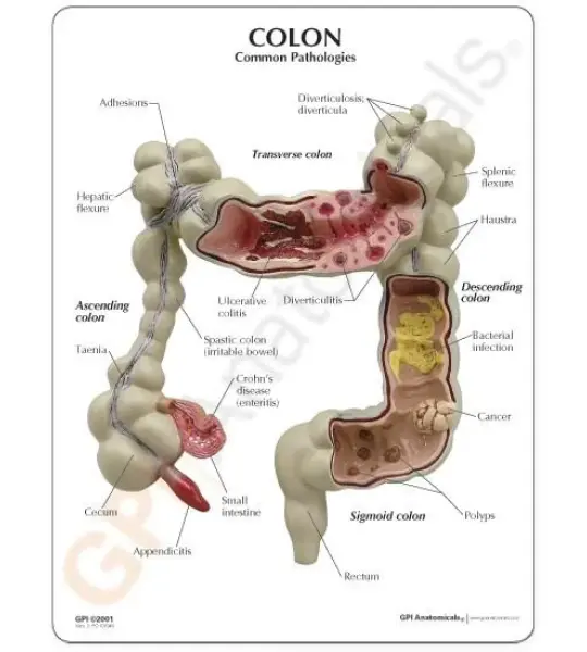 Colon Pathological Model Showing Various Pathologies