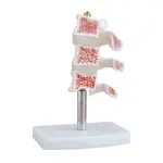 Cutaway Osteoporosis Anatomical Model