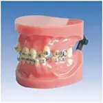 Fixed Orthodontic Model – Dislocation Type