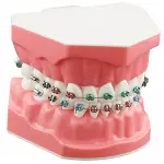 Fixed Orthodontic Model – Dislocation Type