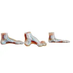 Arched Foot, Normal Foot & Flat Foot - Set of 3 Foot Anatomical Models